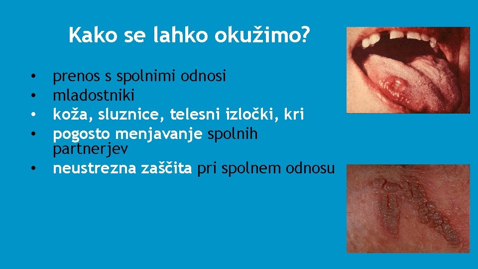 Kako se lahko okužimo? • • • prenos s spolnimi odnosi mladostniki koža, sluznice,