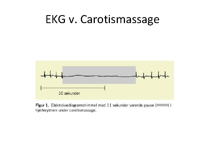 EKG v. Carotismassage 