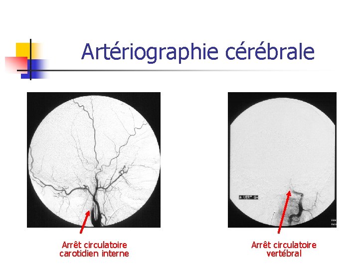 Artériographie cérébrale Arrêt circulatoire carotidien interne Arrêt circulatoire vertébral Artériographie cérébrale Arrêt circulatoire carotidien interne Arrêt circulatoire vertébral