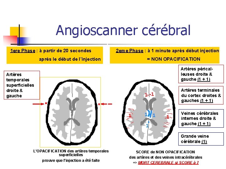 Angioscanner cérébral 1 ere Phase : à partir de 20 secondes après le début Angioscanner cérébral 1 ere Phase : à partir de 20 secondes après le début