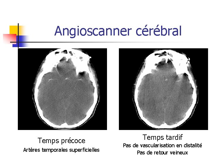 Angioscanner cérébral Temps précoce Artères temporales superficielles Temps tardif Pas de vascularisation en distalité Angioscanner cérébral Temps précoce Artères temporales superficielles Temps tardif Pas de vascularisation en distalité