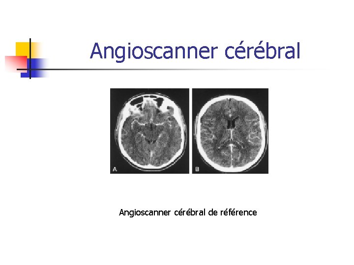 Angioscanner cérébral Temps tardif Angioscanner cérébral de référence Pas de vascularisation en distalité Pas Angioscanner cérébral Temps tardif Angioscanner cérébral de référence Pas de vascularisation en distalité Pas