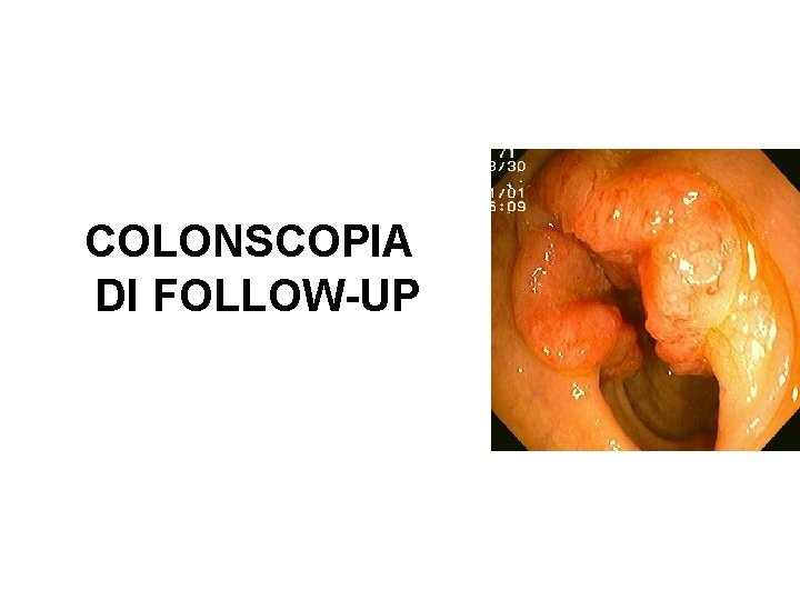 COLONSCOPIA DI FOLLOW-UP 