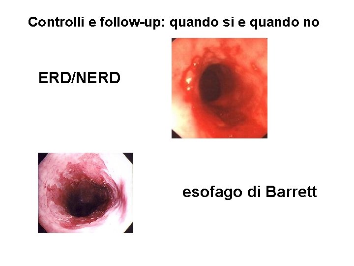 Controlli e follow-up: quando si e quando no ERD/NERD esofago di Barrett 