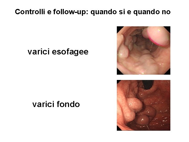 Controlli e follow-up: quando si e quando no varici esofagee varici fondo 