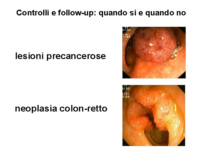 Controlli e follow-up: quando si e quando no lesioni precancerose neoplasia colon-retto 