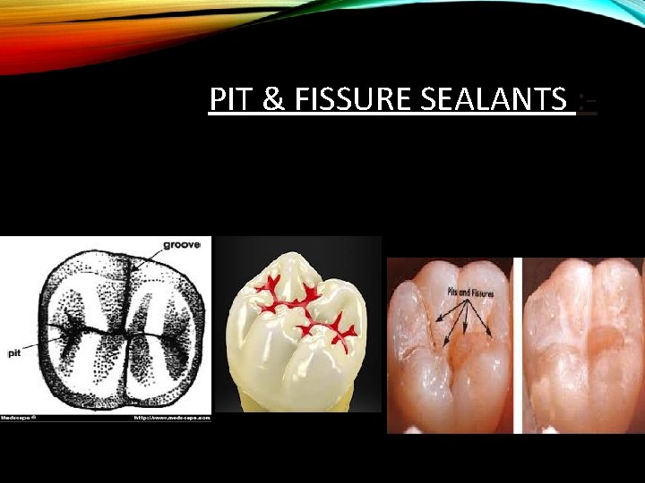 PIT & FISSURE SEALANTS : - 