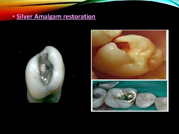  • Silver Amalgam restoration 