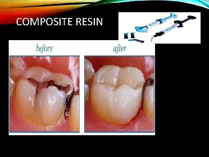 COMPOSITE RESIN 