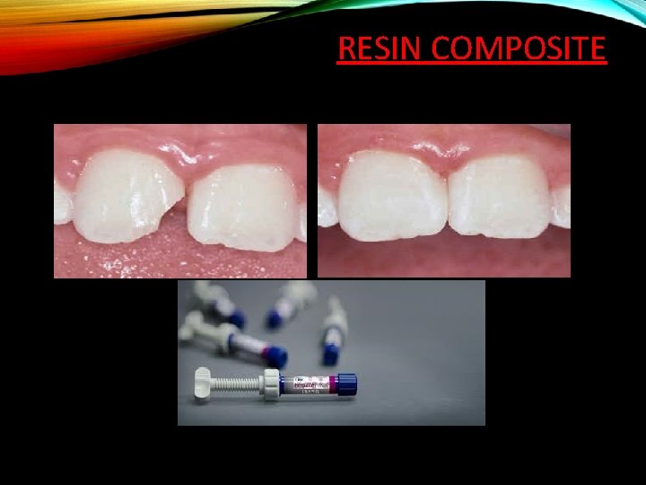 RESIN COMPOSITE 