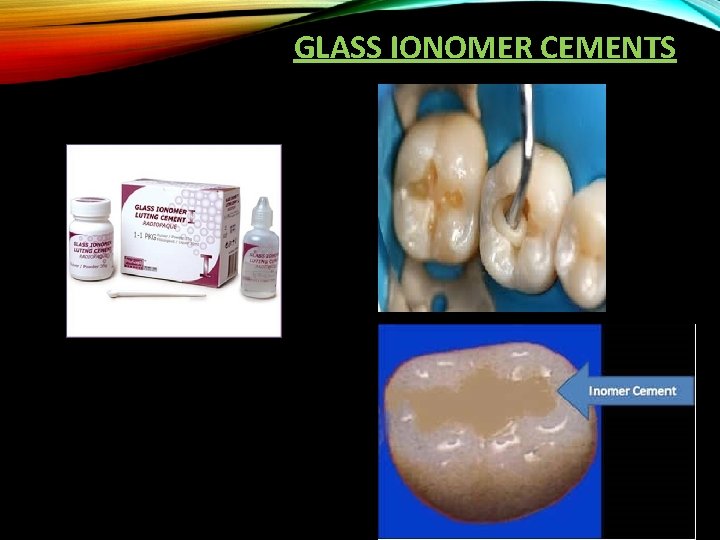 GLASS IONOMER CEMENTS 