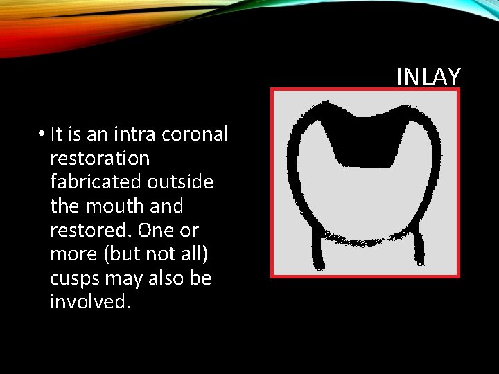 INLAY • It is an intra coronal restoration fabricated outside the mouth and restored.