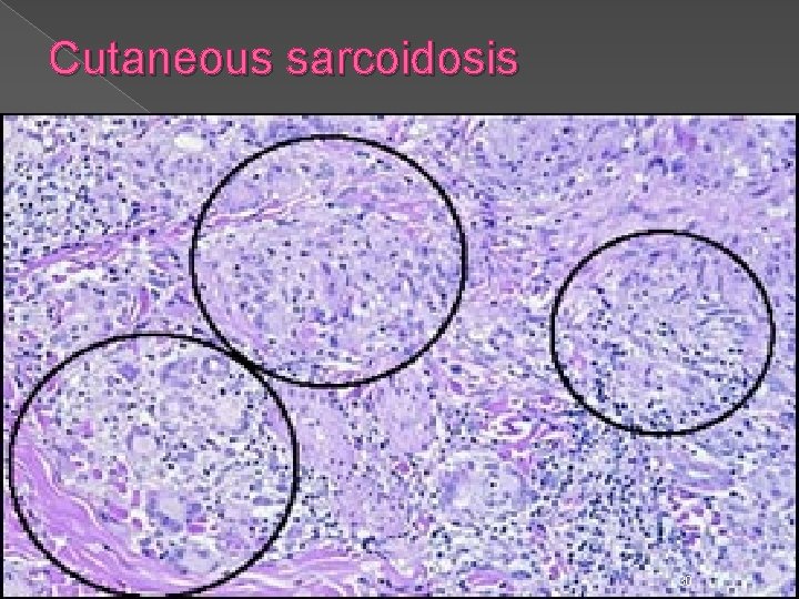 Cutaneous sarcoidosis 30 