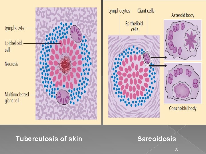  Tuberculosis of skin Sarcoidosis 35 