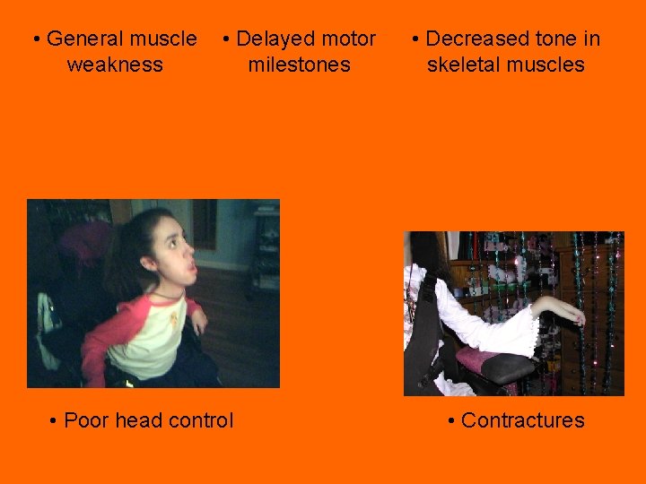  • General muscle weakness • Delayed motor milestones • Poor head control •