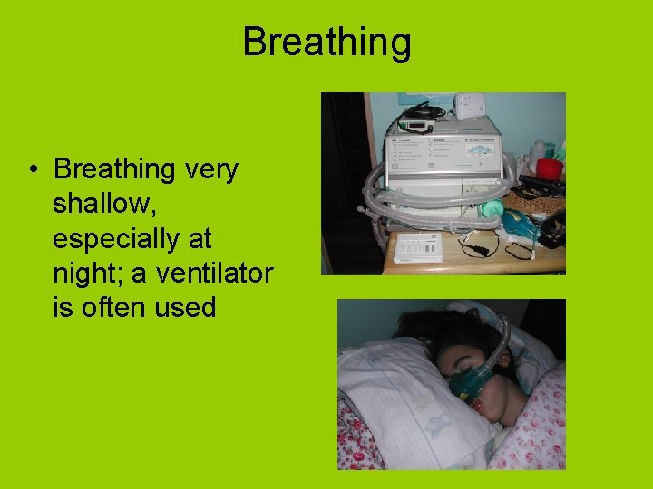 Breathing • Breathing very shallow, especially at night; a ventilator is often used 