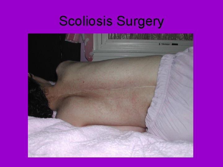 Scoliosis Surgery 