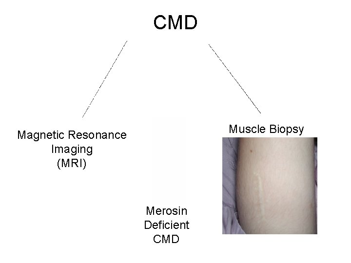CMD Muscle Biopsy Magnetic Resonance Imaging (MRI) Merosin Deficient CMD 
