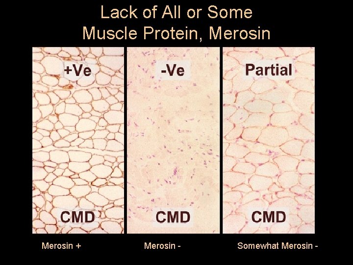 Lack of All or Some Muscle Protein, Merosin + Merosin - Somewhat Merosin -