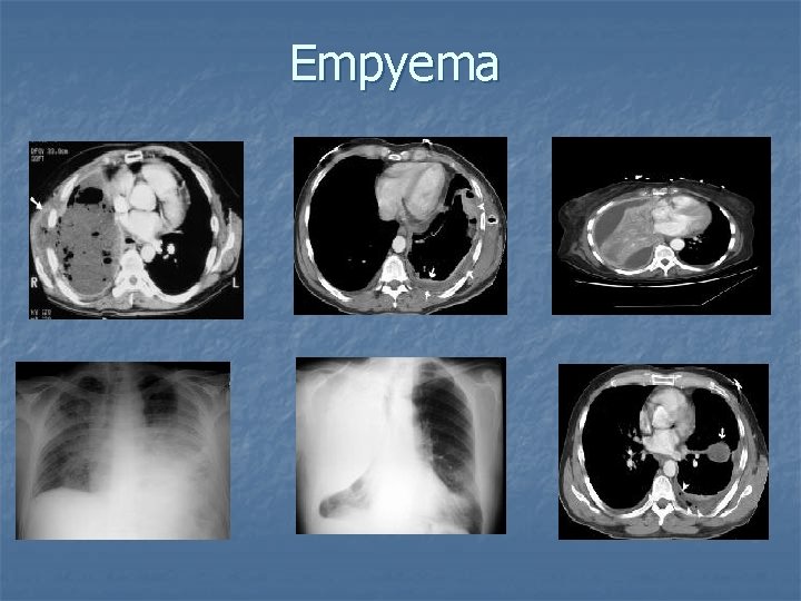 Empyema Empyema