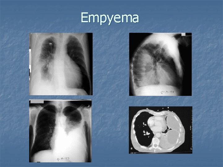 Empyema 