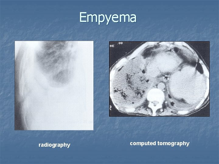 Empyema radiography computed tomography Empyema radiography computed tomography