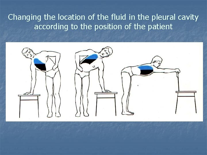 Changing the location of the fluid in the pleural cavity according to the position