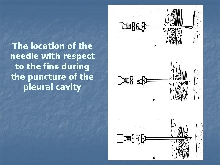 The location of the needle with respect to the fins during the puncture of