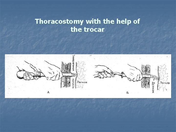 Thoracostomy with the help of the trocar 