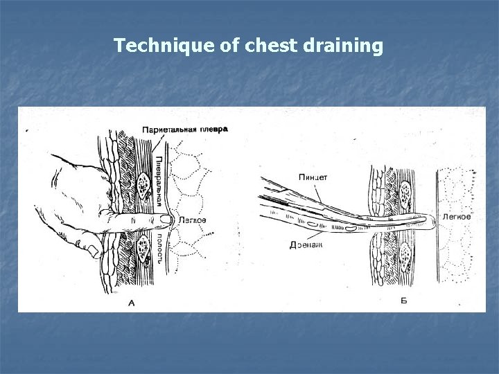 Technique of chest draining 