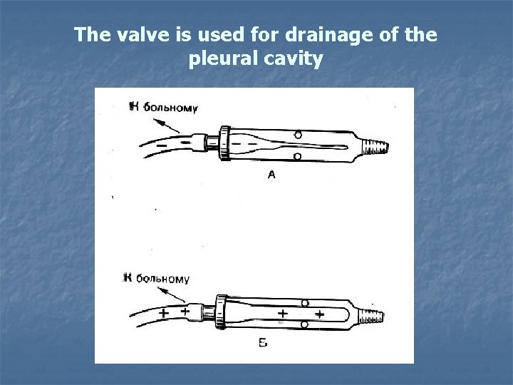 The valve is used for drainage of the pleural cavity The valve is used for drainage of the pleural cavity