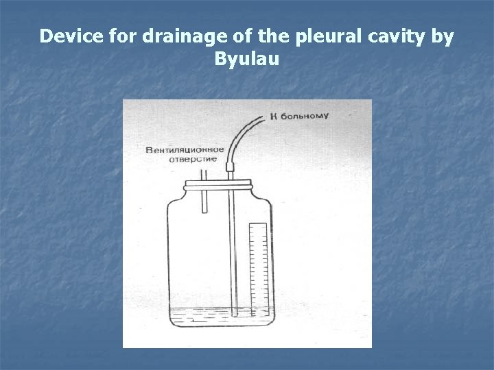 Device for drainage of the pleural cavity by Byulau 