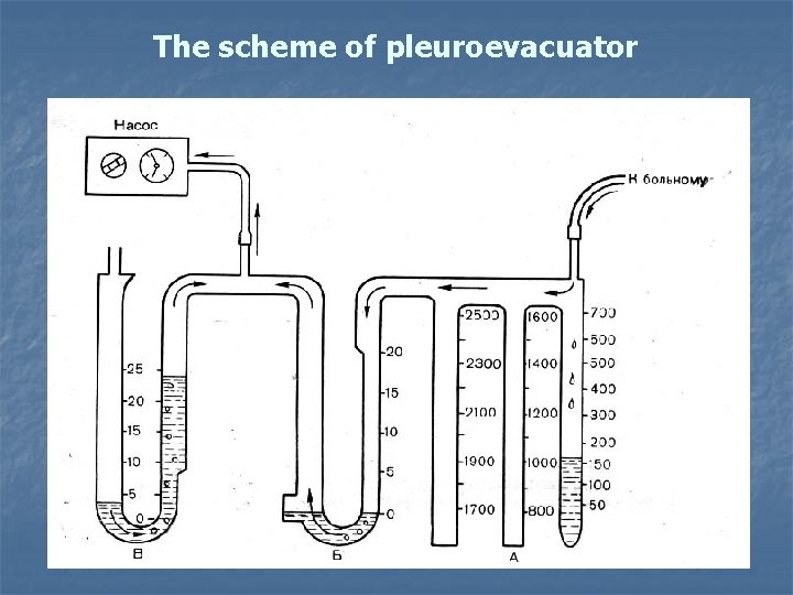 The scheme of pleuroevacuator 