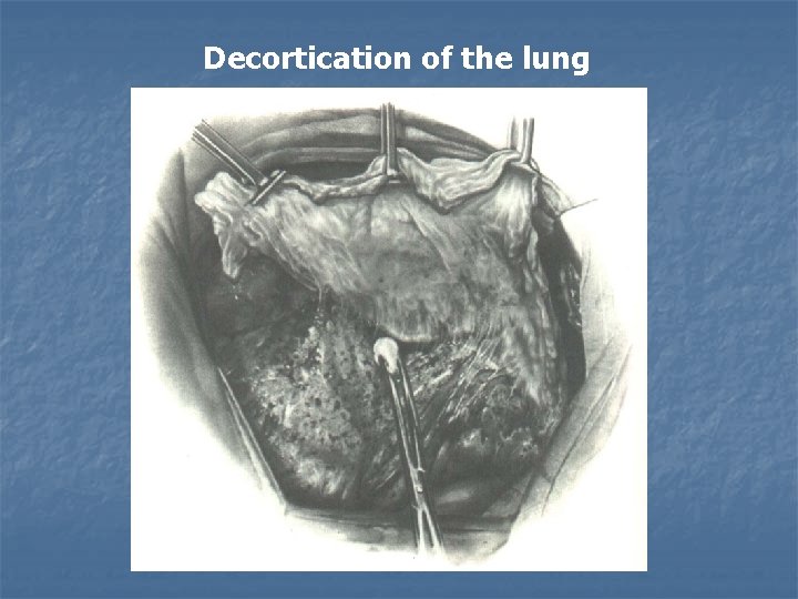 Decortication of the lung 