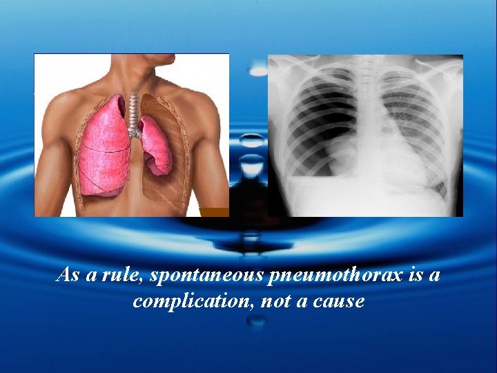 As a rule, spontaneous pneumothorax is a complication, not a cause 