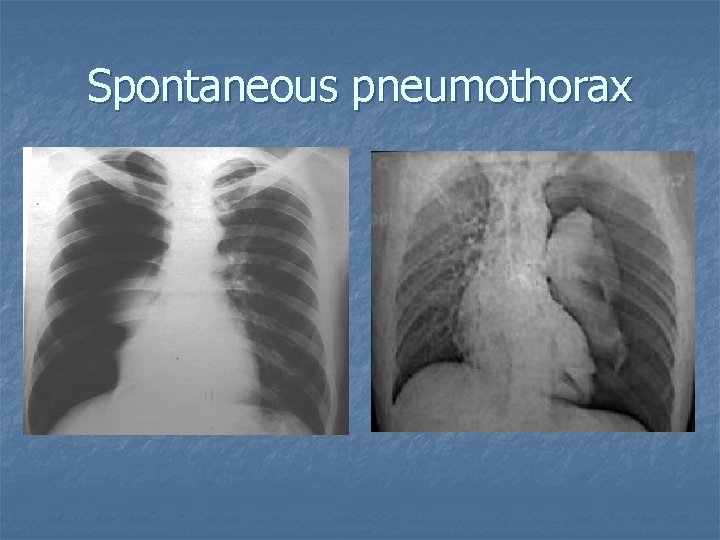 Spontaneous pneumothorax 