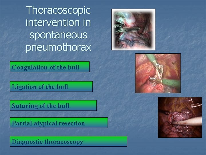 Thoracoscopic intervention in spontaneous pneumothorax Coagulation of the bull Ligation of the bull Suturing