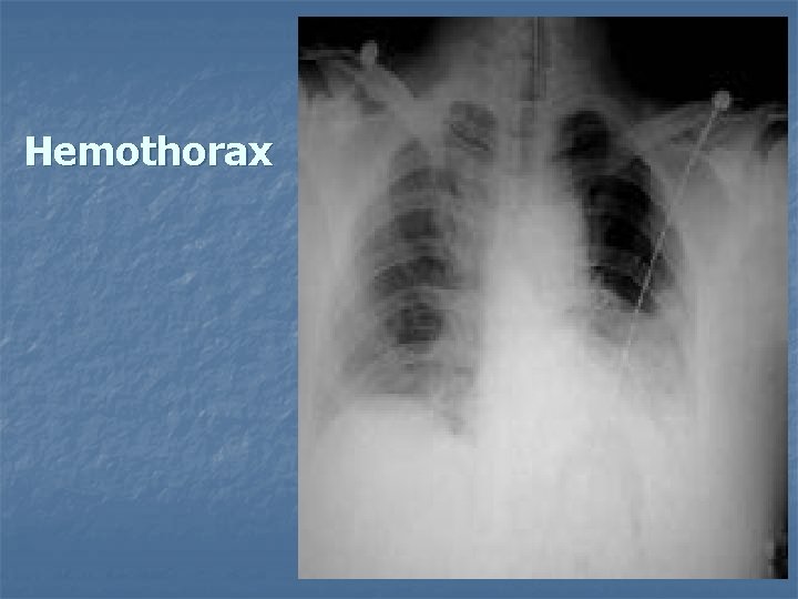 Hemothorax 