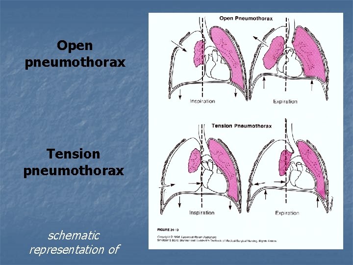 Open pneumothorax Tension pneumothorax schematic representation of 