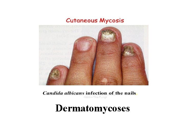 Dermatomycoses 