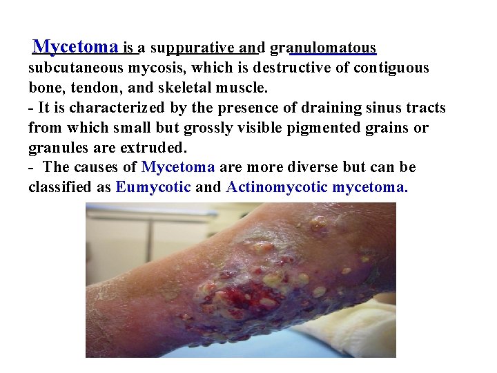 Mycetoma is a suppurative and granulomatous subcutaneous mycosis, which is destructive of contiguous bone,