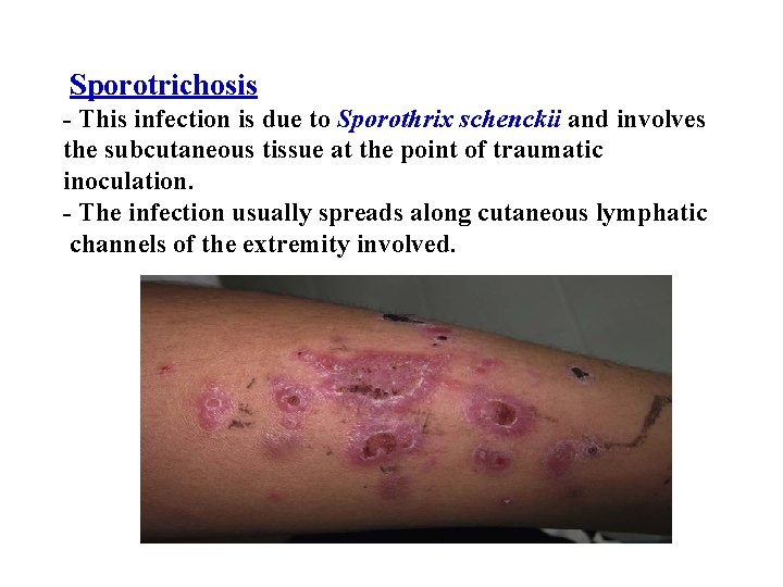 Sporotrichosis - This infection is due to Sporothrix schenckii and involves the subcutaneous tissue