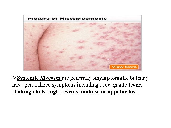 ØSystemic Mycoses are generally Asymptomatic but may have generalized symptoms including : low grade