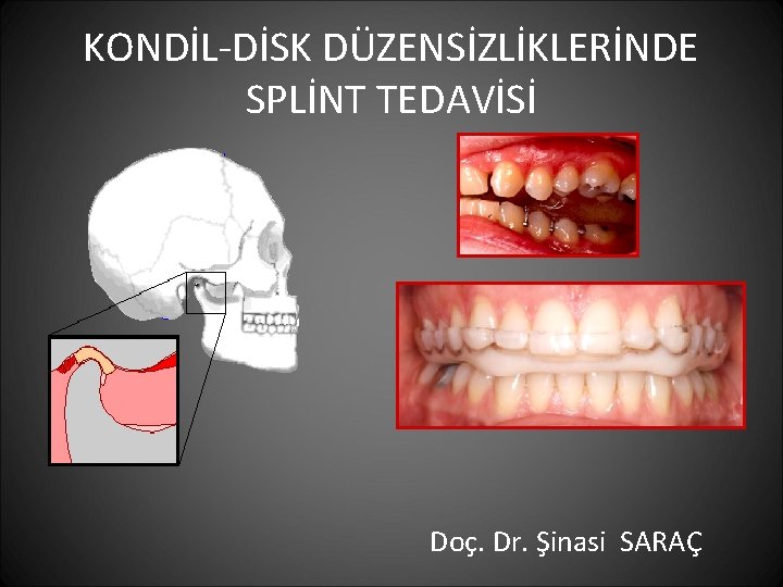 KONDİL-DİSK DÜZENSİZLİKLERİNDE SPLİNT TEDAVİSİ Doç. Dr. Şinasi SARAÇ 