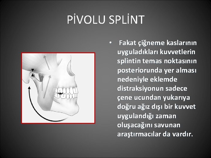PİVOLU SPLİNT • Fakat çiğneme kaslarının uyguladıkları kuvvetlerin splintin temas noktasının posteriorunda yer alması