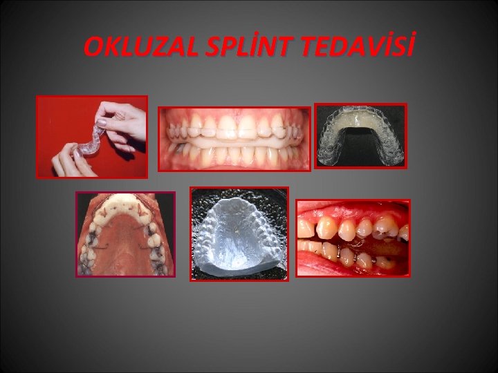 OKLUZAL SPLİNT TEDAVİSİ 