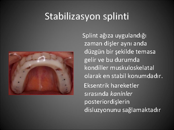 Stabilizasyon splinti Splint ağıza uygulandığı zaman dişler aynı anda düzgün bir şekilde temasa gelir