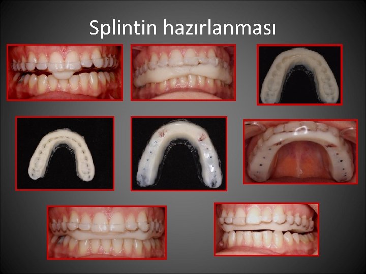 Splintin hazırlanması 