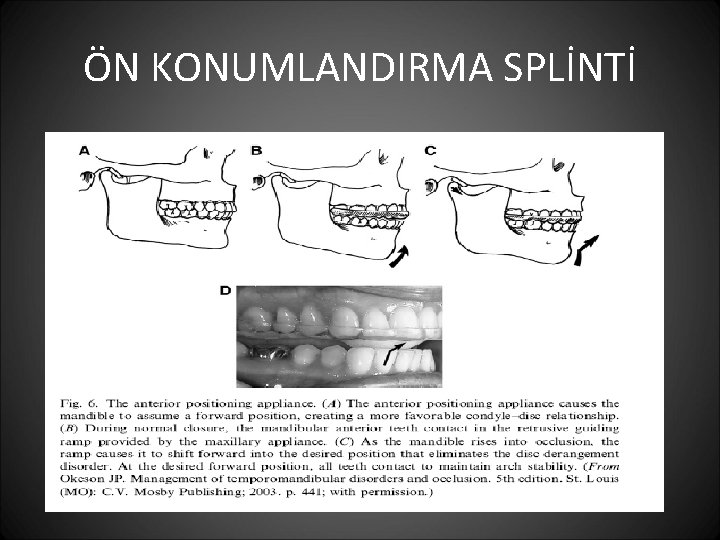 ÖN KONUMLANDIRMA SPLİNTİ 