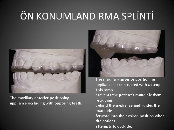 ÖN KONUMLANDIRMA SPLİNTİ The maxillary anterior positioning appliance occluding with opposing teeth. The maxillary
